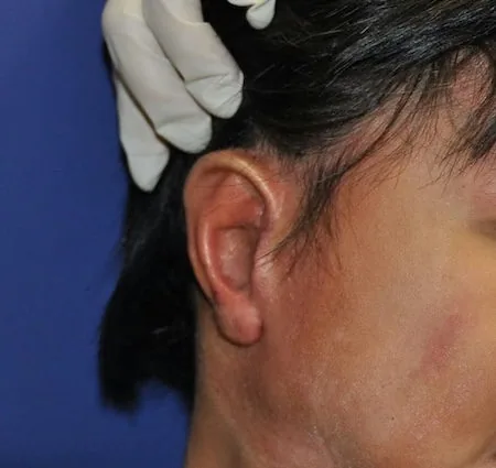 After second stage microtia surgery showing completed earlobe rotation, tragus formation, and conchal deepening