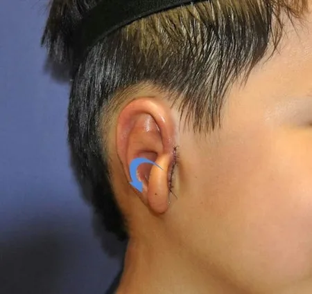 Before second stage microtia surgery showing ear position prior to earlobe rotation and tragus formation