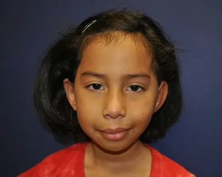 After third stage microtia surgery showing final ear elevation result with natural projection away from the head