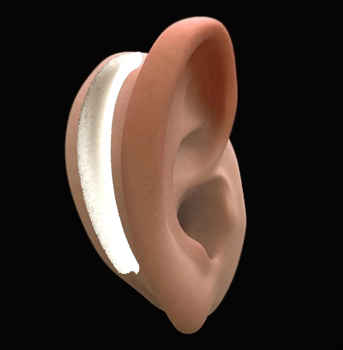 Before third stage microtia surgery showing ear prior to elevation procedure giving the ear its natural projection