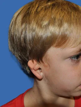 Microtia de grado II antes de la cirugía: paciente 63 antes de la reconstrucción auricular realizada por el Dr. Arturo Bonilla