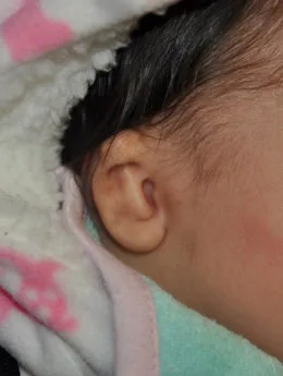 Microtia de grado II antes de la cirugía: paciente 27 antes de la reconstrucción auricular realizada por el Dr. Arturo Bonilla