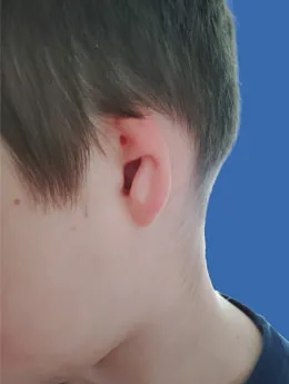 Microtia de grado II antes de la cirugía: paciente 66 antes de la reconstrucción auricular realizada por el Dr. Arturo Bonilla