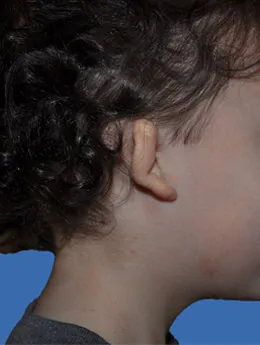 Microtia de grado II antes de la cirugía: paciente 41 antes de la reconstrucción auricular realizada por el Dr. Arturo Bonilla