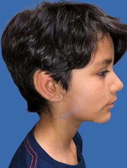 Resultado postoperatorio: paciente 4 después de la reconstrucción auricular con cartílago costal natural realizada por el Dr. Arturo Bonilla