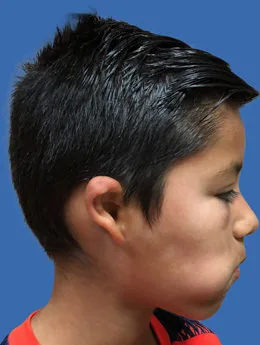 Microtia de grado II antes de la cirugía: paciente 4 antes de la reconstrucción auricular realizada por el Dr. Arturo Bonilla