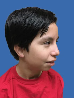 Resultado postoperatorio: paciente 42 después de la reconstrucción auricular con cartílago costal natural realizada por el Dr. Arturo Bonilla