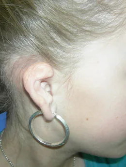 Microtia de grado II antes de la cirugía: paciente 30 antes de la reconstrucción auricular realizada por el Dr. Arturo Bonilla