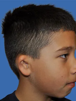 Microtia de grado II antes de la cirugía: paciente 19 antes de la reconstrucción auricular realizada por el Dr. Arturo Bonilla