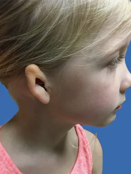 Microtia de grado II antes de la cirugía: paciente 5 antes de la reconstrucción auricular realizada por el Dr. Arturo Bonilla