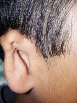 Microtia de grado II antes de la cirugía: paciente 33 antes de la reconstrucción auricular realizada por el Dr. Arturo Bonilla