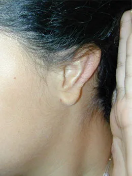 Resultado postoperatorio: paciente 15 después de la reconstrucción auricular con cartílago costal natural realizada por el Dr. Arturo Bonilla