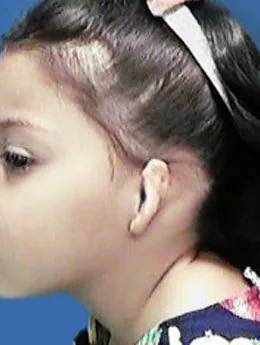 Microtia de grado II antes de la cirugía: paciente 15 antes de la reconstrucción auricular realizada por el Dr. Arturo Bonilla