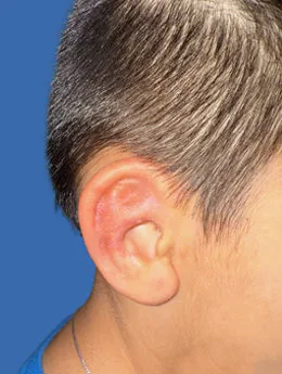 Resultado postoperatorio: paciente 47 después de la reconstrucción auricular con cartílago costal natural realizada por el Dr. Arturo Bonilla