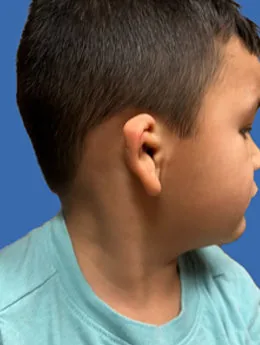 Microtia de grado II antes de la cirugía: paciente 47 antes de la reconstrucción auricular realizada por el Dr. Arturo Bonilla