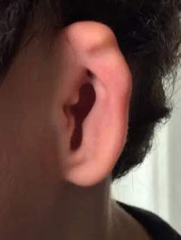 Microtia de grado II antes de la cirugía: paciente 68 antes de la reconstrucción auricular realizada por el Dr. Arturo Bonilla