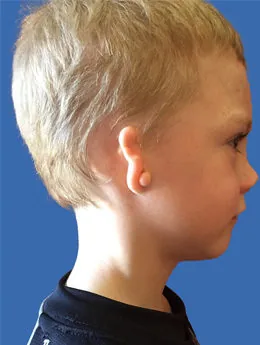 Microtia de grado III antes de la cirugía: paciente 29 antes de la reconstrucción auricular realizada por el Dr. Arturo Bonilla