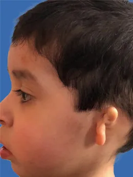 Microtia de grado III antes de la cirugía: paciente 40 antes de la reconstrucción auricular realizada por el Dr. Arturo Bonilla