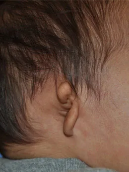Microtia de grado III antes de la cirugía: paciente 62 antes de la reconstrucción auricular realizada por el Dr. Arturo Bonilla