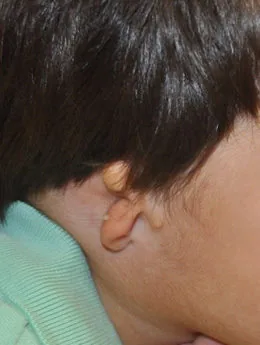 Microtia de grado III antes de la cirugía: paciente 17 antes de la reconstrucción auricular realizada por el Dr. Arturo Bonilla