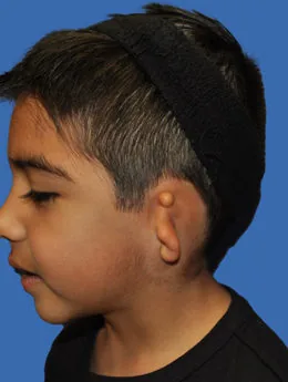 Microtia de grado III antes de la cirugía: paciente 24 antes de la reconstrucción auricular realizada por el Dr. Arturo Bonilla