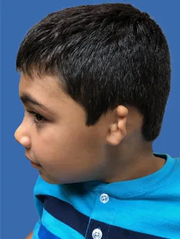 Microtia de grado III antes de la cirugía: paciente 53 antes de la reconstrucción auricular realizada por el Dr. Arturo Bonilla