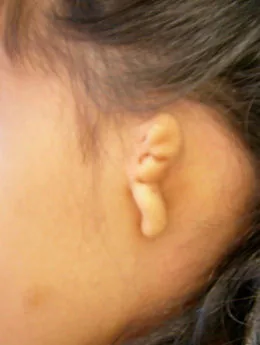 Microtia de grado III antes de la cirugía: paciente 6 antes de la reconstrucción auricular realizada por el Dr. Arturo Bonilla
