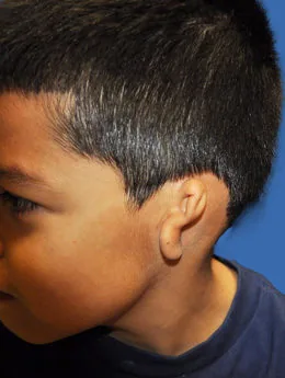 Microtia de grado III antes de la cirugía: paciente 28 antes de la reconstrucción auricular realizada por el Dr. Arturo Bonilla