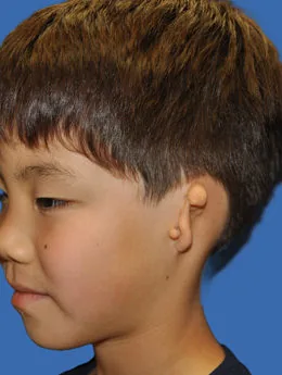 Microtia de grado III antes de la cirugía: paciente 39 antes de la reconstrucción auricular realizada por el Dr. Arturo Bonilla