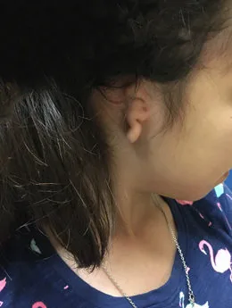 Microtia de grado III antes de la cirugía: paciente 44 antes de la reconstrucción auricular realizada por el Dr. Arturo Bonilla