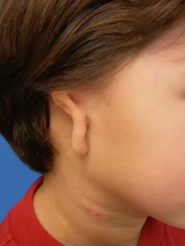 Microtia de grado III antes de la cirugía: paciente 12 antes de la reconstrucción auricular realizada por el Dr. Arturo Bonilla