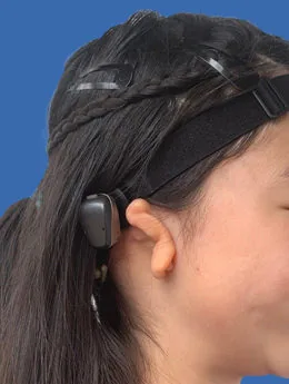 Microtia de grado III antes de la cirugía: paciente 49 antes de la reconstrucción auricular realizada por el Dr. Arturo Bonilla