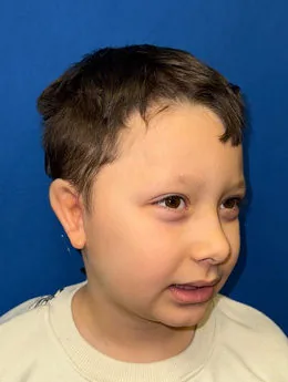 Resultado postoperatorio: paciente 20 después de la reconstrucción auricular con cartílago costal natural realizada por el Dr. Arturo Bonilla