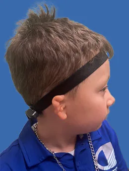 Microtia de grado III antes de la cirugía: paciente 20 antes de la reconstrucción auricular realizada por el Dr. Arturo Bonilla