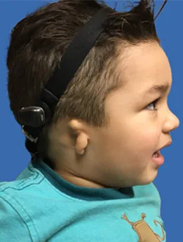 Microtia de grado III antes de la cirugía: paciente 51 antes de la reconstrucción auricular realizada por el Dr. Arturo Bonilla