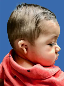 Microtia de grado III antes de la cirugía: paciente 1 antes de la reconstrucción auricular realizada por el Dr. Arturo Bonilla