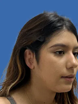 Resultado postoperatorio: paciente 70 después de la reconstrucción auricular con cartílago costal natural realizada por el Dr. Arturo Bonilla