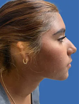 Microtia de grado III antes de la cirugía: paciente 70 antes de la reconstrucción auricular realizada por el Dr. Arturo Bonilla