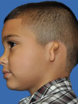 Microtia de grado III antes de la cirugía: paciente 46 antes de la reconstrucción auricular realizada por el Dr. Arturo Bonilla