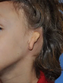 Microtia de grado III antes de la cirugía: paciente 25 antes de la reconstrucción auricular realizada por el Dr. Arturo Bonilla