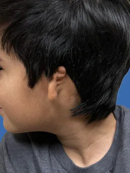 Microtia de grado III antes de la cirugía: paciente 32 antes de la reconstrucción auricular realizada por el Dr. Arturo Bonilla
