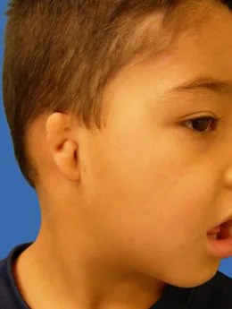 Microtia de grado III antes de la cirugía: paciente 43 antes de la reconstrucción auricular realizada por el Dr. Arturo Bonilla