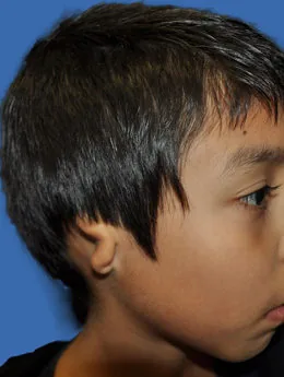 Microtia de grado III antes de la cirugía: paciente 52 antes de la reconstrucción auricular realizada por el Dr. Arturo Bonilla