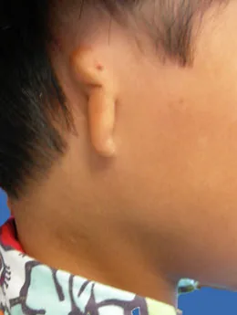 Microtia de grado III antes de la cirugía: paciente 9 antes de la reconstrucción auricular realizada por el Dr. Arturo Bonilla