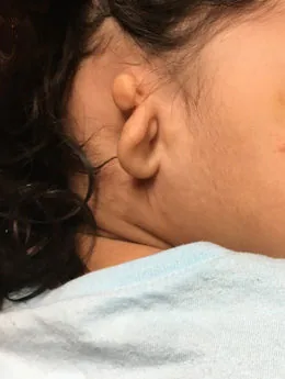 Microtia de grado III antes de la cirugía: paciente 31 antes de la reconstrucción auricular realizada por el Dr. Arturo Bonilla