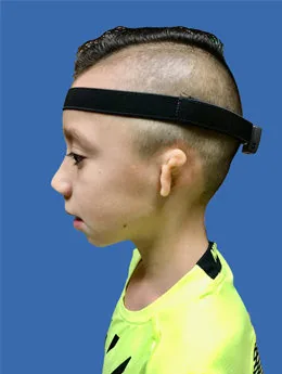 Microtia de grado III antes de la cirugía: paciente 69 antes de la reconstrucción auricular realizada por el Dr. Arturo Bonilla