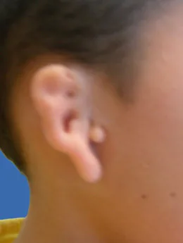 Microtia de grado III antes de la cirugía: paciente 36 antes de la reconstrucción auricular realizada por el Dr. Arturo Bonilla