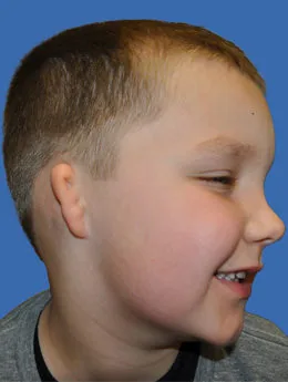 Microtia de grado III antes de la cirugía: paciente 65 antes de la reconstrucción auricular realizada por el Dr. Arturo Bonilla