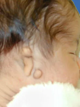 Microtia de grado III antes de la cirugía: paciente 2 antes de la reconstrucción auricular realizada por el Dr. Arturo Bonilla