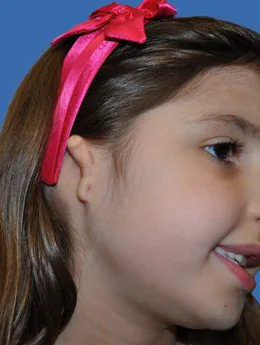 Microtia de grado III antes de la cirugía: paciente 60 antes de la reconstrucción auricular realizada por el Dr. Arturo Bonilla